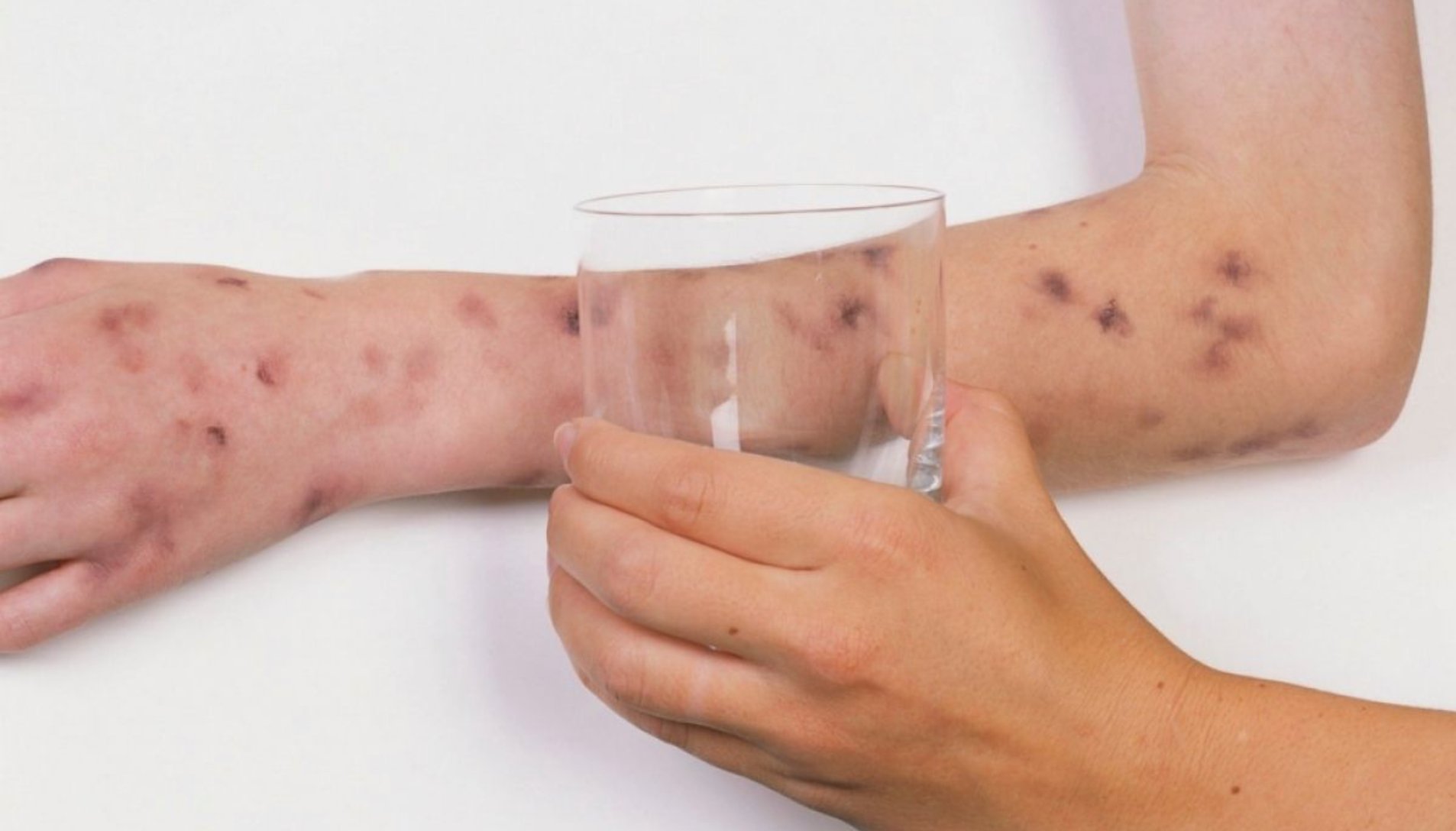 ХӨСҮТ: Бэлтгэсэн уусмалаар хоолойгоо зайлах нь Менингококкт халдвараас сэргийлнэ